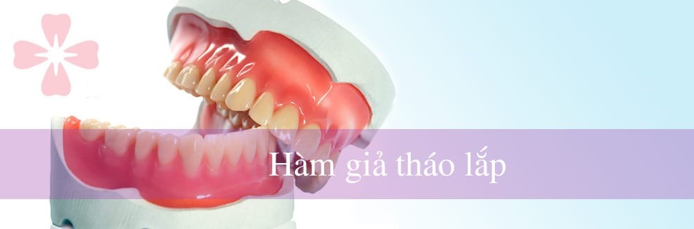 Hàm răng giả tháo lắp là gì?