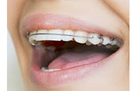Hawley retainer 2