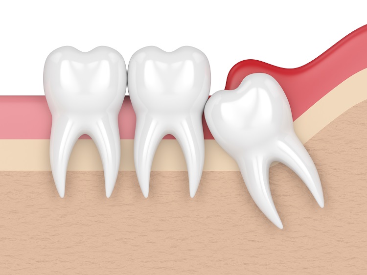 impacted teeth