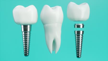 đặt implant nha khoa