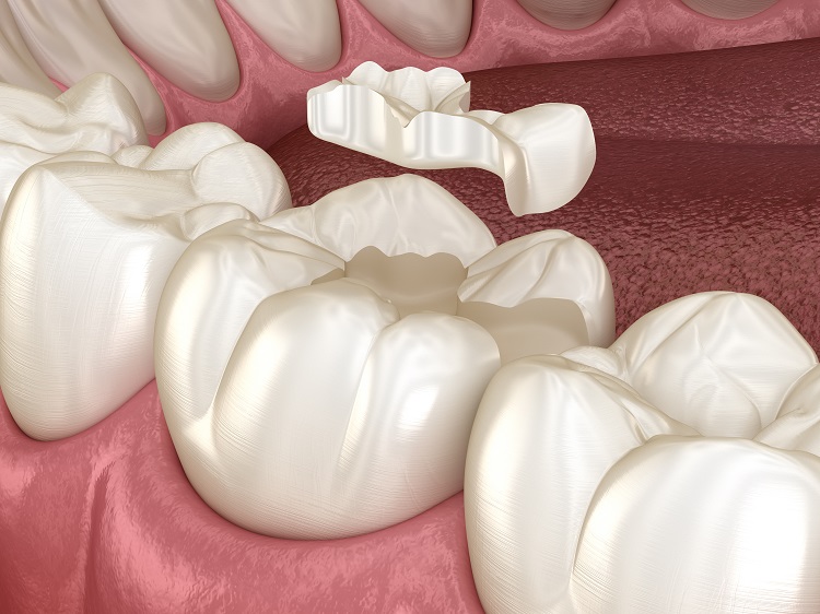 inlays fillings