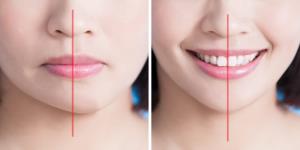 Chỉnh hình cằm lệch