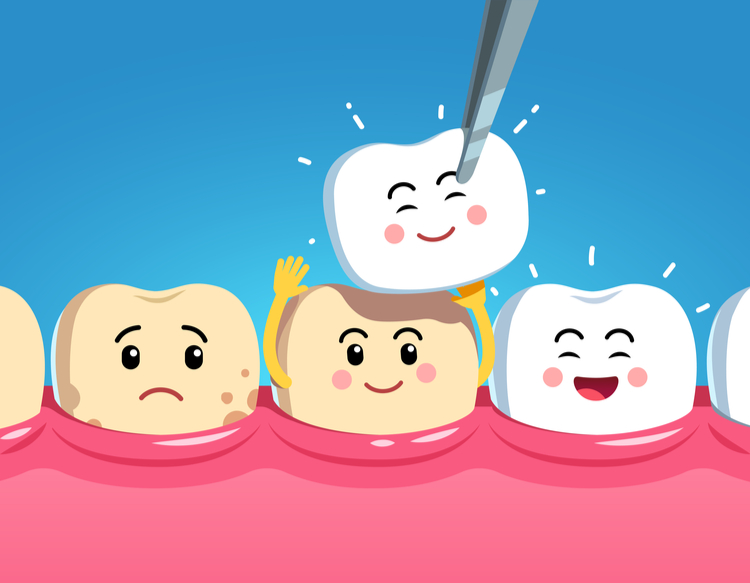 lợi ích mặt dán sứ veneer