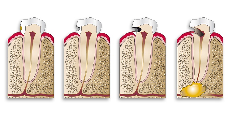 Molar cavities: Causes and Prevention