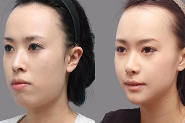 How much does underbite jaw surgery cost?