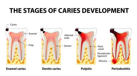 the stages of caries development
