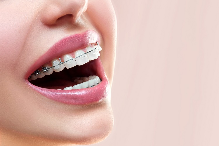 niềng răng mắc cài sứ