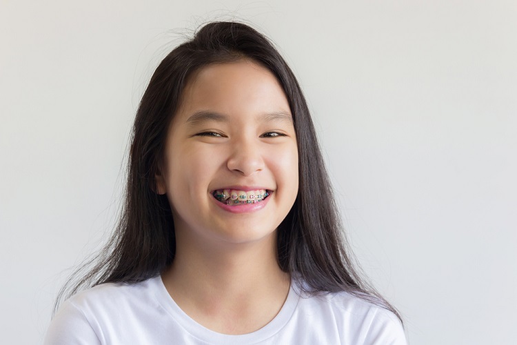 niềng răng trẻ em