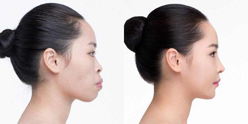Current surgical methods of receding chin