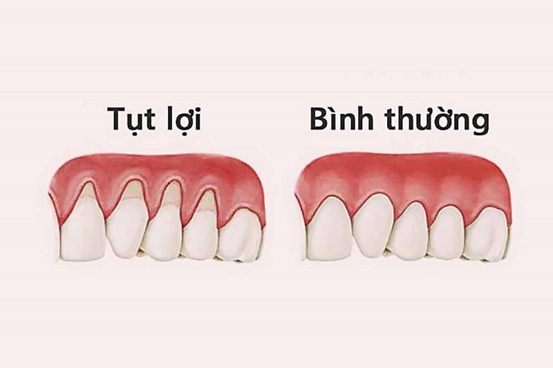 Có nên lựa chọn phương pháp phẫu thuật thẩm mỹ nướu cho người bị tụt nướu
