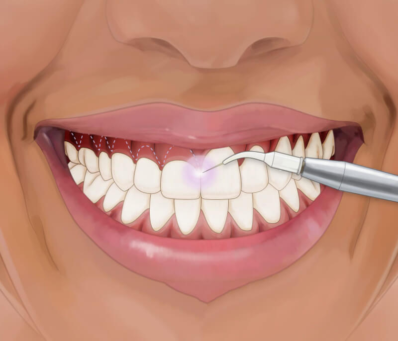 Phẫu thuật thẩm mỹ nướu có nguy hiểm không