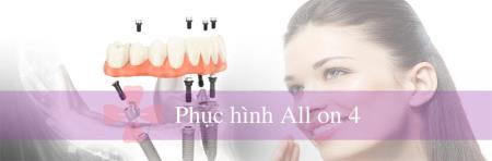 Quy trình trồng răng Implant All-on-4 cho người mất răng toàn hàm