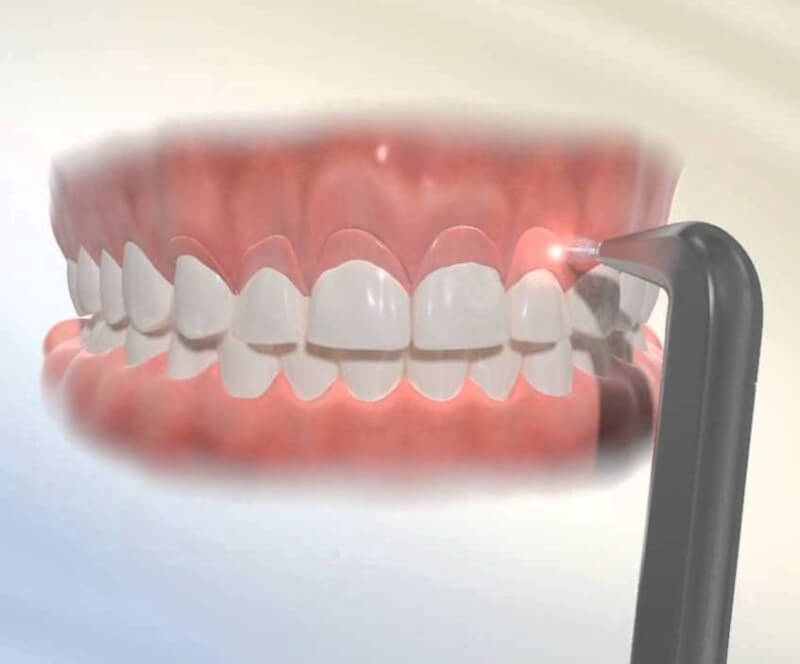Các phương pháp phẫu thuật thẩm mỹ nướu hiện đại nhất