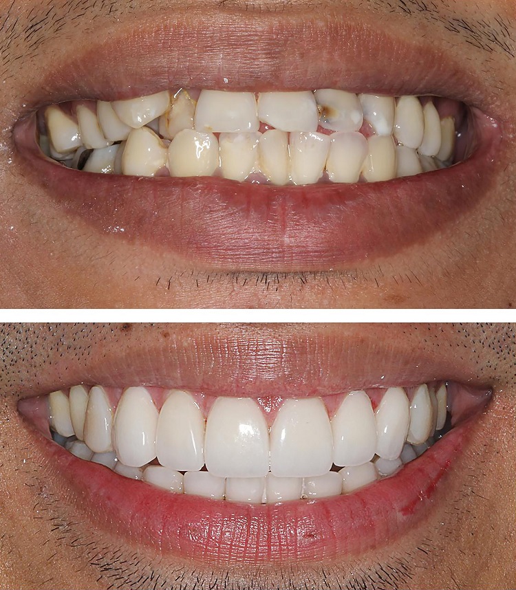 porcelain crowns for misaligned front teeth