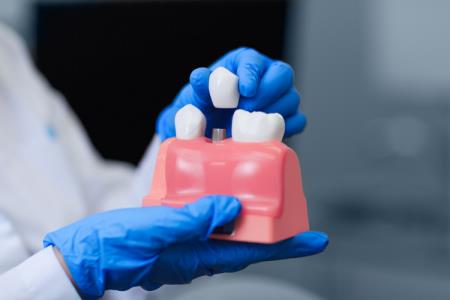 How Long Does the Dental Implant Process Take?