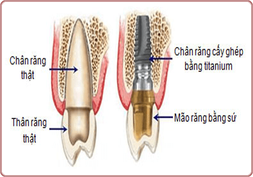 Răng cấy ghép