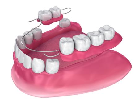 Removable dentures