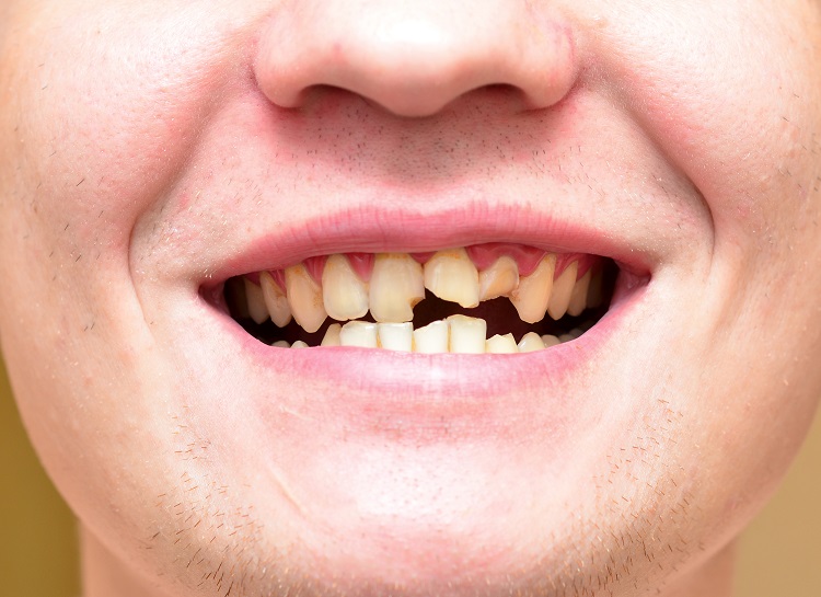 tooth broke horizontally