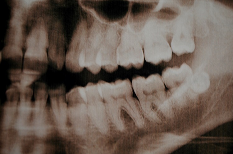 too many teeth