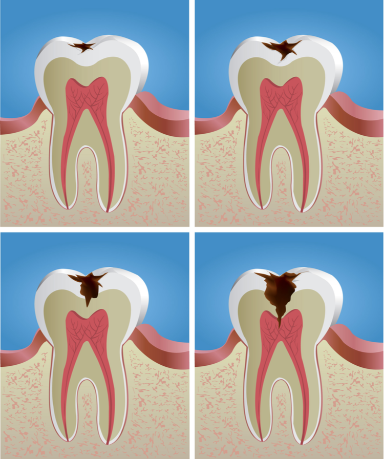 trị sâu răng tận gốc an toàn
