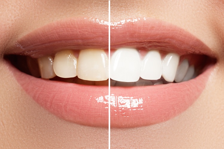 Hollywood smile