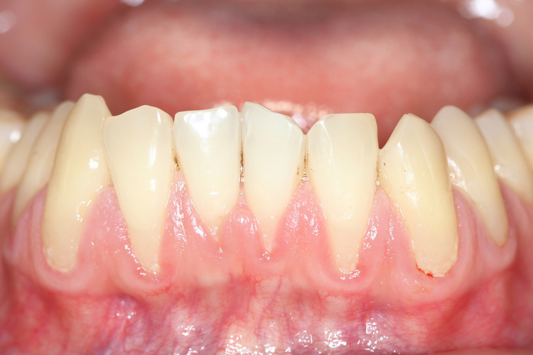 Tìm hiểu về tụt nướu chân răng, nguyên nhân và hướng điều trị