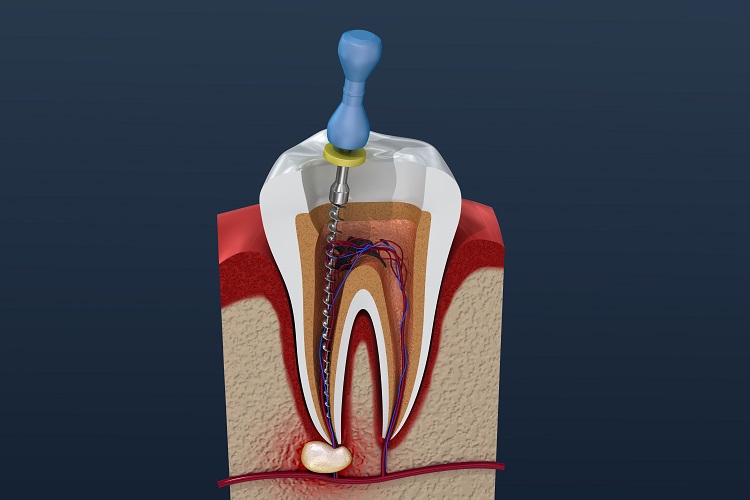 What is pulpitis? How to prevent pulpitis?