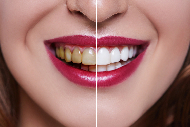 Porcelain veneer procedure for a radiant smile