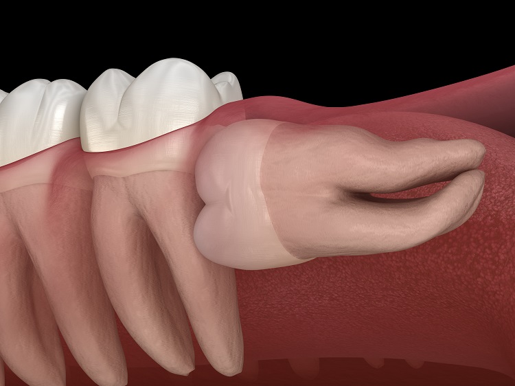 wisdom teeth